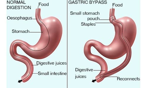 Weight Loss Surgery Abroad: Gastric Bypass & Sleeve Cost Guide 2026