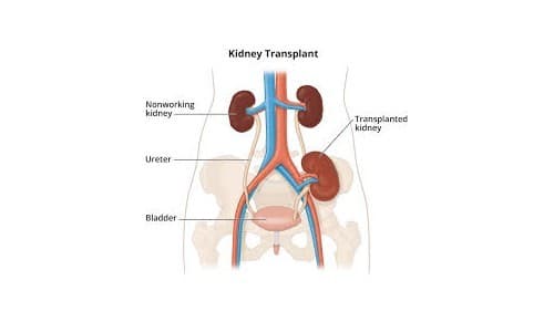 Kidney Transplantation