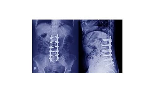 Spine Surgeries